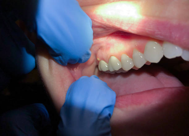 Best Emergency Dental Extractions in Jnstown, OH